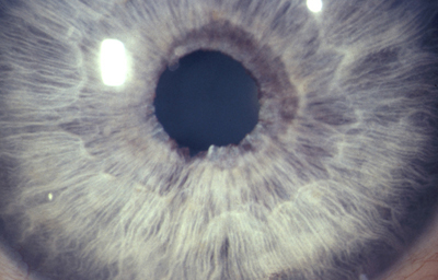 Coloboma