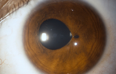 Coloboma