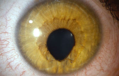 Coloboma