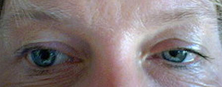 Heterocromia