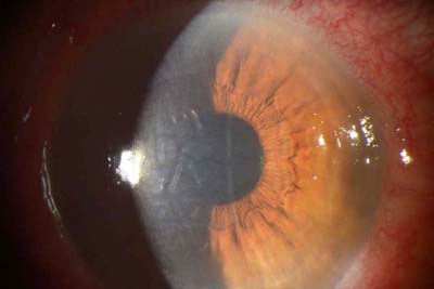 Descompenzación Corneal