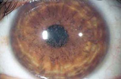 Distrofia Corneal