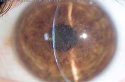 Distrofia Corneal