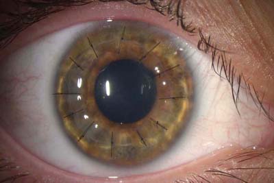 Queratoplastia Laminar