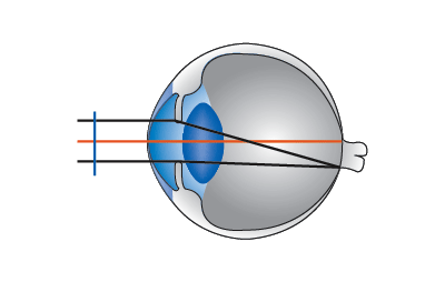 Diagrama Visión Aberrada