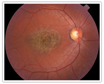 Retinografía, Agujero Macular