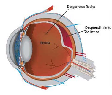 Diagrama Desprendimiento de Retina