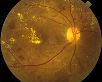 Retinopatía Diabética